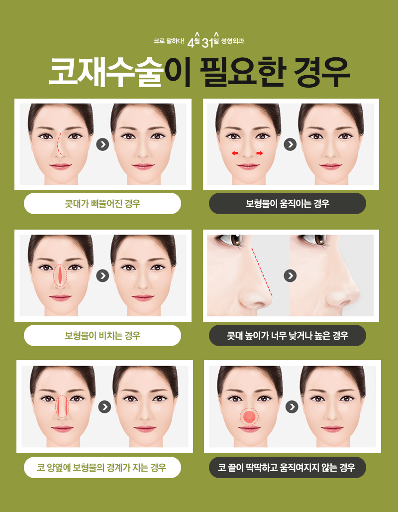 구축코재수술유명한곳 4월31일 성형외과에서 이젠 마지막으로! 관련 이미지 4