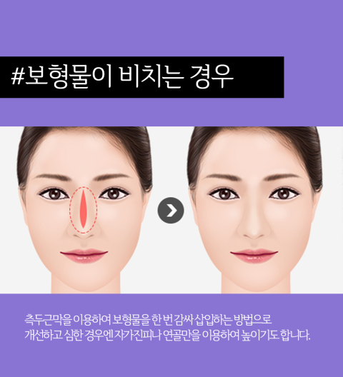 The Difference Between Experience and Skill! April 31 Plastic Surgery, Specialist in Nose Revision Surgery image 4