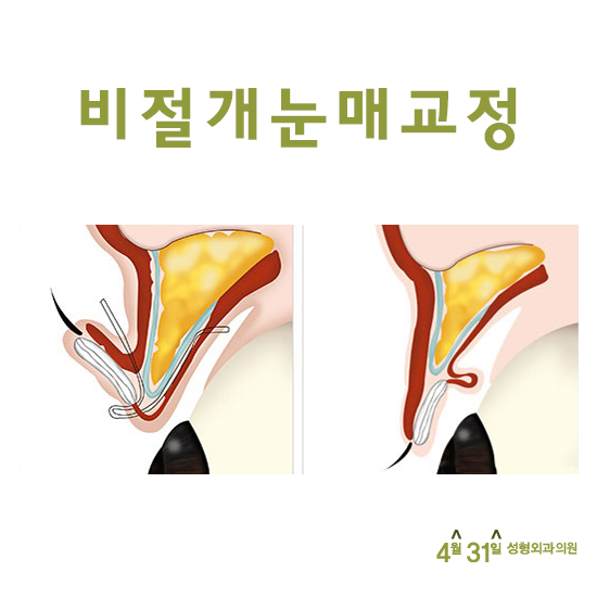 비절개눈매교정전후 비교해보면 4월31일성형외과의원 관련 이미지 3