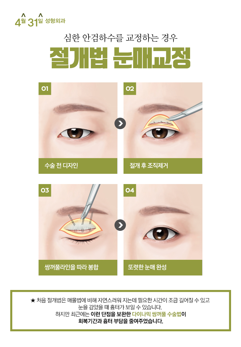 강남눈매교정술 4월31일성형외과의 노하우! 관련 이미지 5