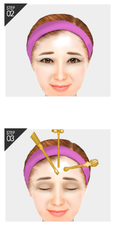 [Facelift Surgery] Endoscopic Forehead Lift or Brow Lift: Which Case Am I? image 6