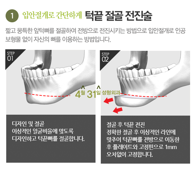 무턱수술잘하는곳 4월31일성형외과에서 알아보세요! 관련 이미지 4