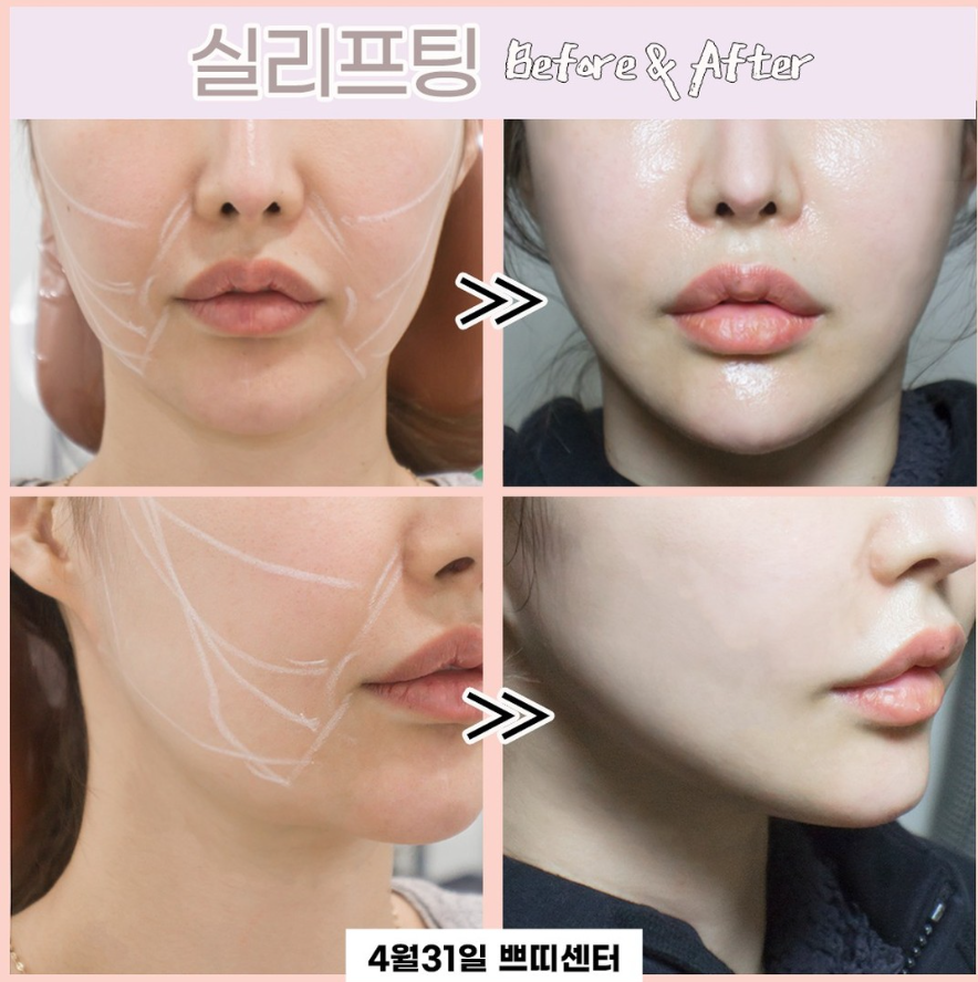 Where is the best dermatology clinic for Mint thread lifting near Hakdong Station and Gangnam Station? Criteria for choosing a dermatology clinic! image 9