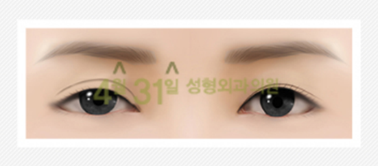 쌍커풀재수술 더이상은 없도록 4월31일성형외과 관련 이미지 5