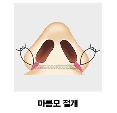 [코성형] 아름다운 코 모양의 완성은? 4/31 콧볼축소수술 관련 이미지 5
