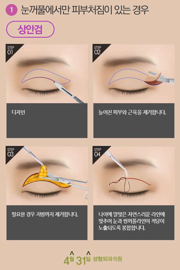 상안검수술붓기 걱정 없는 4월31일성형외과 관련 이미지 2