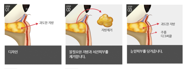 하안검잘하는곳 찾고 있다면 4월31일성형외과의원 관련 이미지 2