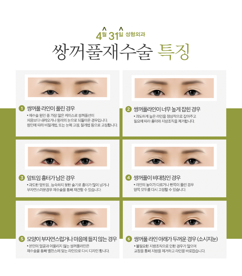 쌍꺼풀재수술잘하는병원 한가지만 보자! 관련 이미지 3