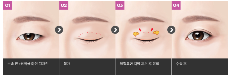 [눈성형] 내눈에는 어떤 방법이 최선일까? (매몰/절개/부분절개) 관련 이미지 5