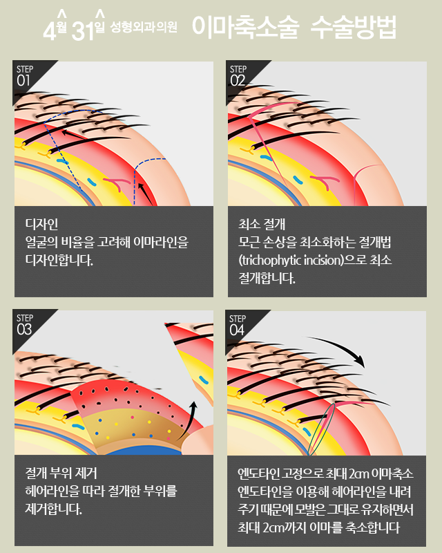 헤어라인수술 4월31일성형외과의원에서 넓은 이마 축소 관련 이미지 3