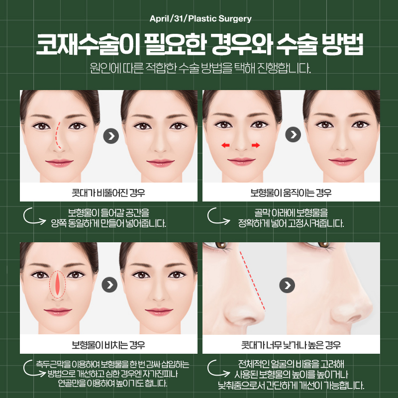 [Nose Revision Surgery] 4월31일 Plastic Surgery That Considers the Next 10 or 20 Years image 4