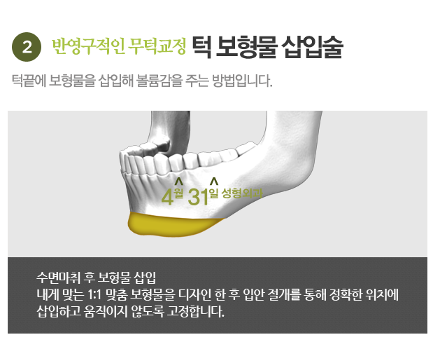 무턱수술잘하는곳 4월31일성형외과에서 알아보세요! 관련 이미지 5