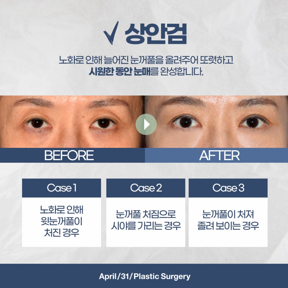 상안검하안검 주름으로 고민이라면? 관련 이미지 3