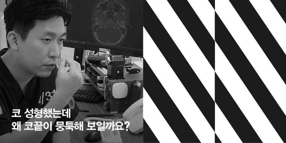 [4월31일성형외과] 코 성형했는데 왜 코끝이 뭉툭해 보일까요? 관련 이미지 1