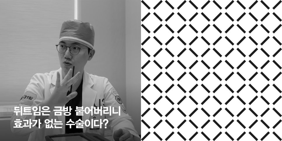 [April 31 Plastic Surgery] Does the outer corner eye surgery really reattach? image 1