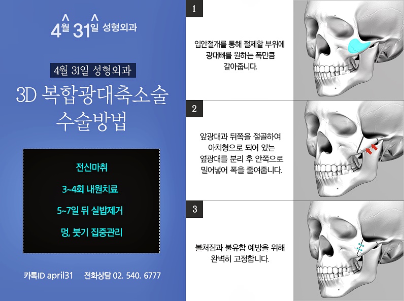광대축소 정답은 4월31일성형외과 관련 이미지 6