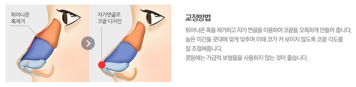 매부리코수술잘하는병원 추천 4월31일성형외과의원 관련 이미지 6