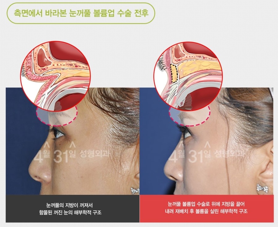 눈꺼풀볼륨업 신뢰할 수 있는 곳! 관련 이미지 3