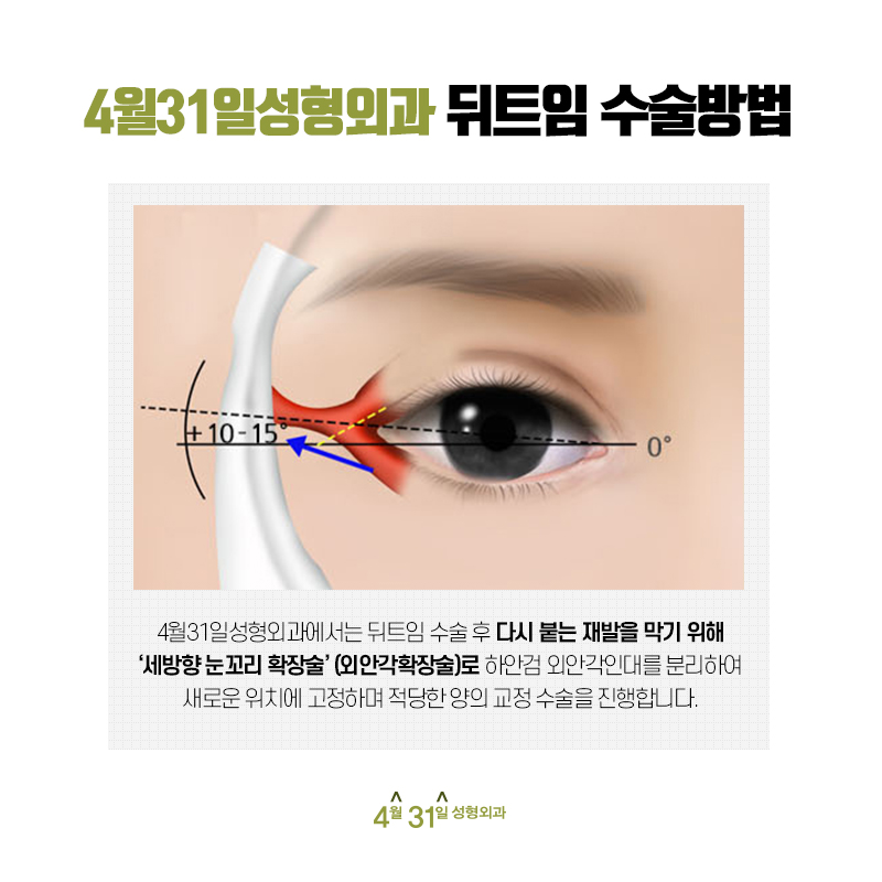 The Effect of Lateral Canthoplasty: No More Feeling Constricted image 4