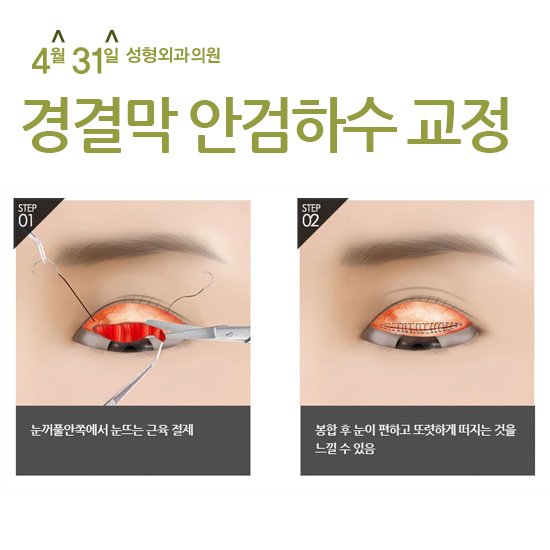 안검하수 눈매교정으로 또렷한 눈매로 거듭나다! 관련 이미지 4