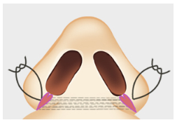 [Nose Surgery] Is It Possible to Reduce a Bulbous Nose with Alar Reduction? Yes or No? image 5