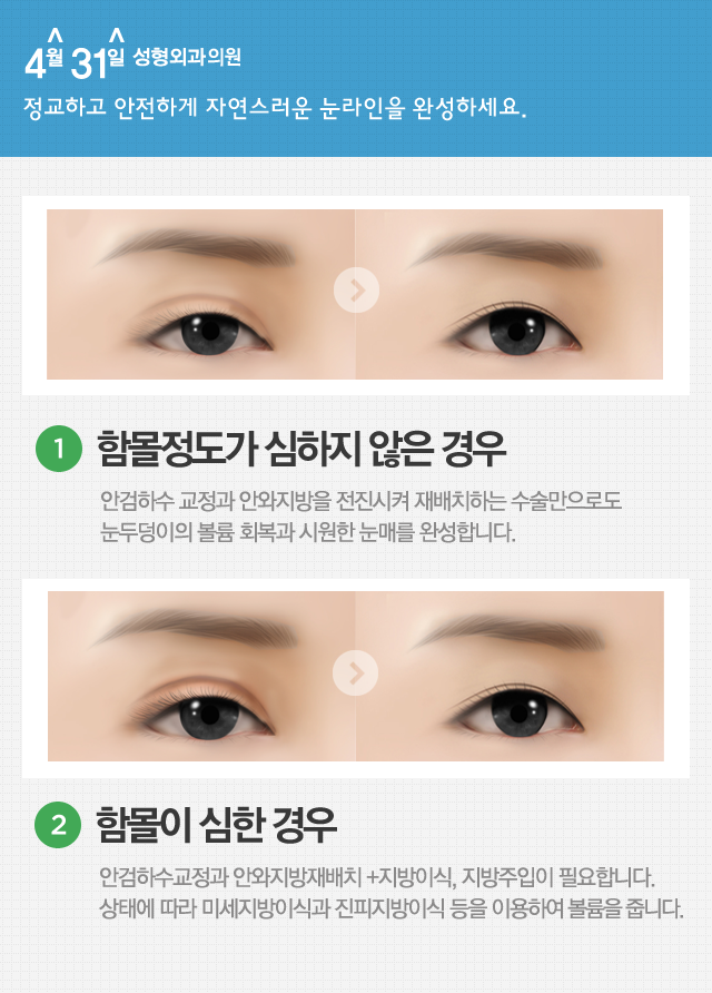 눈꺼풀꺼짐수술 4월31일성형외과의원은 관련 이미지 3