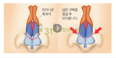 매부리코교정 4월31일성형외과의원에서 굴곡없이 관련 이미지 4
