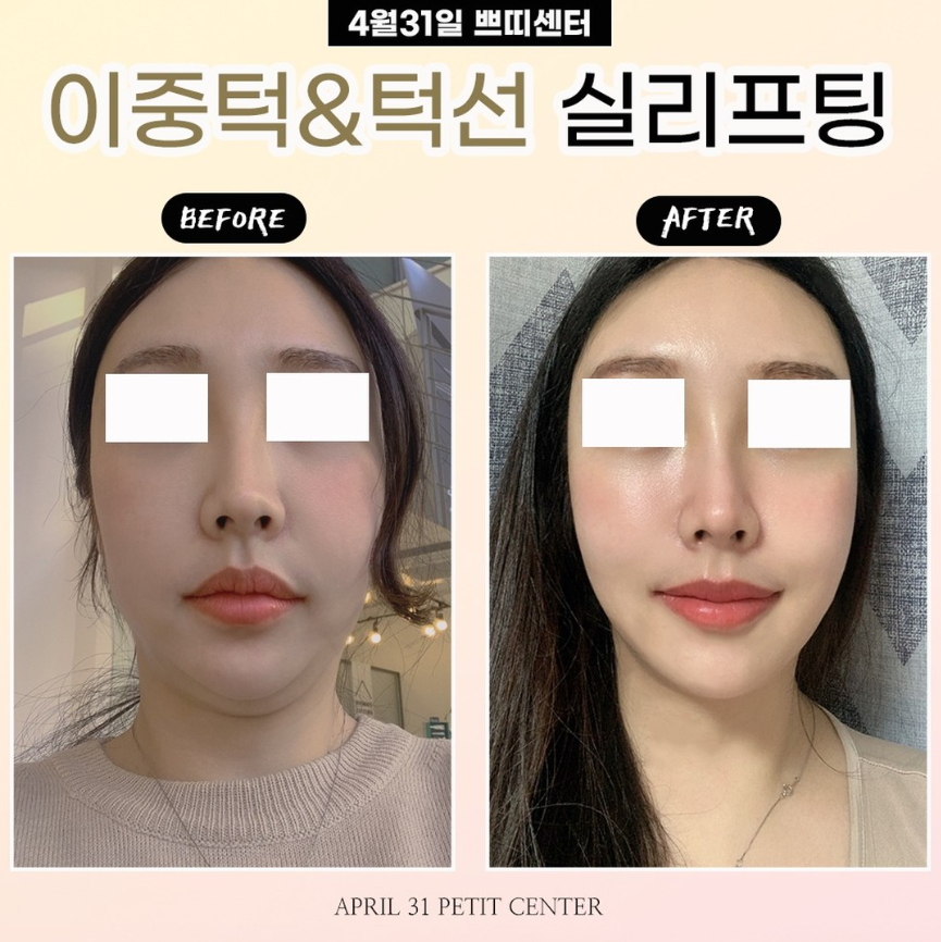 Where is the best dermatology clinic for Mint thread lifting near Hakdong Station and Gangnam Station? Criteria for choosing a dermatology clinic! image 8