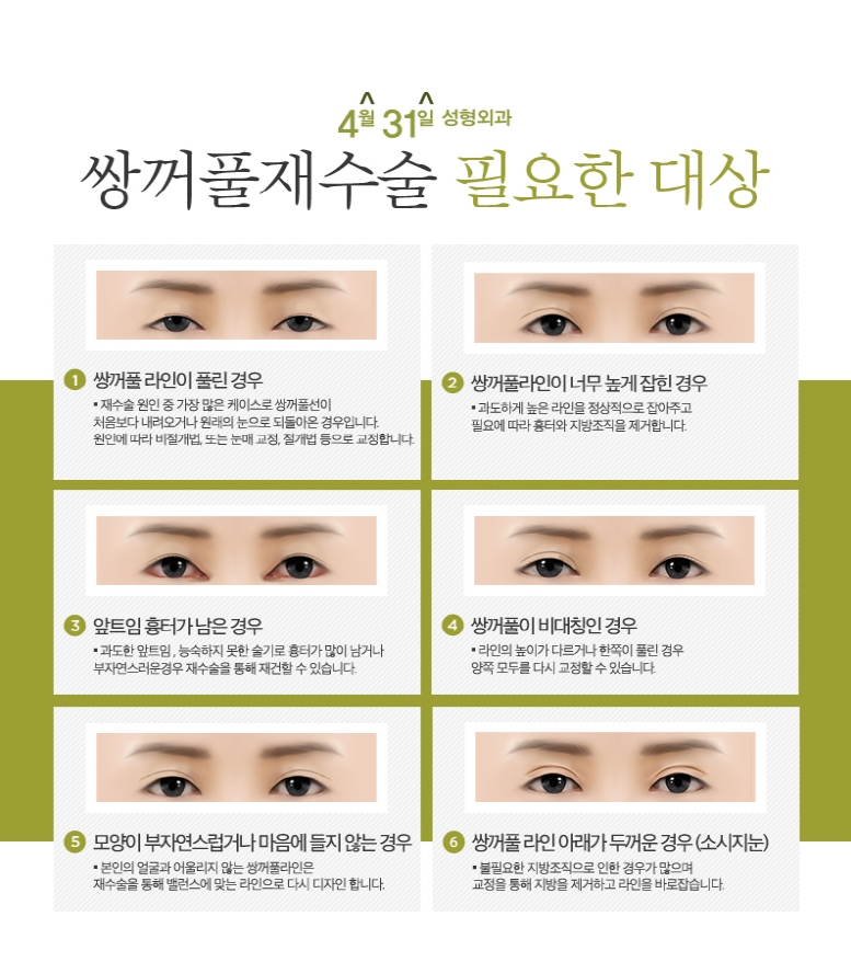 강남쌍꺼풀재수술가격 합리적인 4월31일성형외과 관련 이미지 2