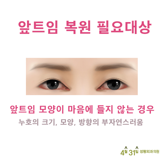앞트임재건후기 추천병원 4월31일성형외과의원 관련 이미지 2