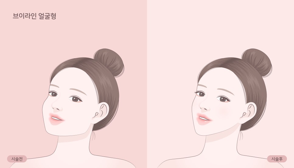 [April 31 Petit Center] What Causes a Square Jaw That Contour Injections Can’t Fix? (feat. Salivary Gland Botox) image 3