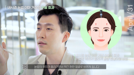 [Facelift Surgery] Endoscopic Forehead Lift or Brow Lift: Which Case Am I? image 4