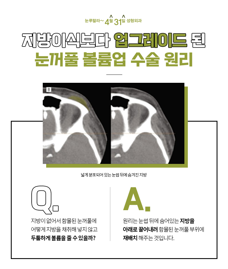 눈꺼풀지방이식보다 더 효과적으로 볼륨을 개선하는 방법은? 관련 이미지 4