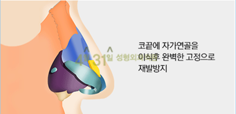 짧은코성형 4월31일성형외과의원에서 해결! 관련 이미지 3