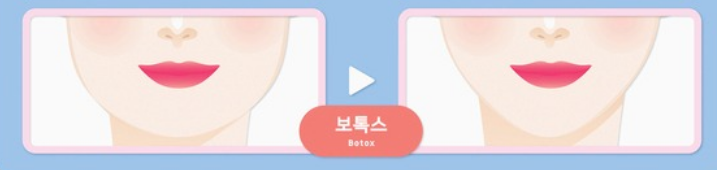 V라인 완성하는 가성비 시술(턱보톡스/윤곽주사/턱끝필러) 관련 이미지 4