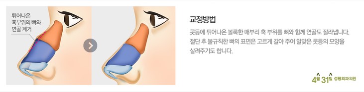 매부리코수술잘하는병원 추천 4월31일성형외과의원 관련 이미지 4