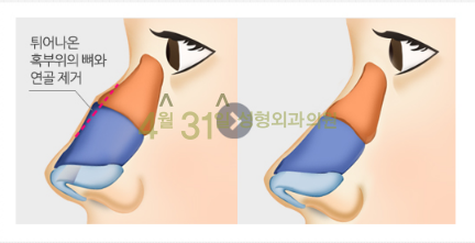 매부리코수술잘하는병원 고민하고 계신가요? 관련 이미지 4