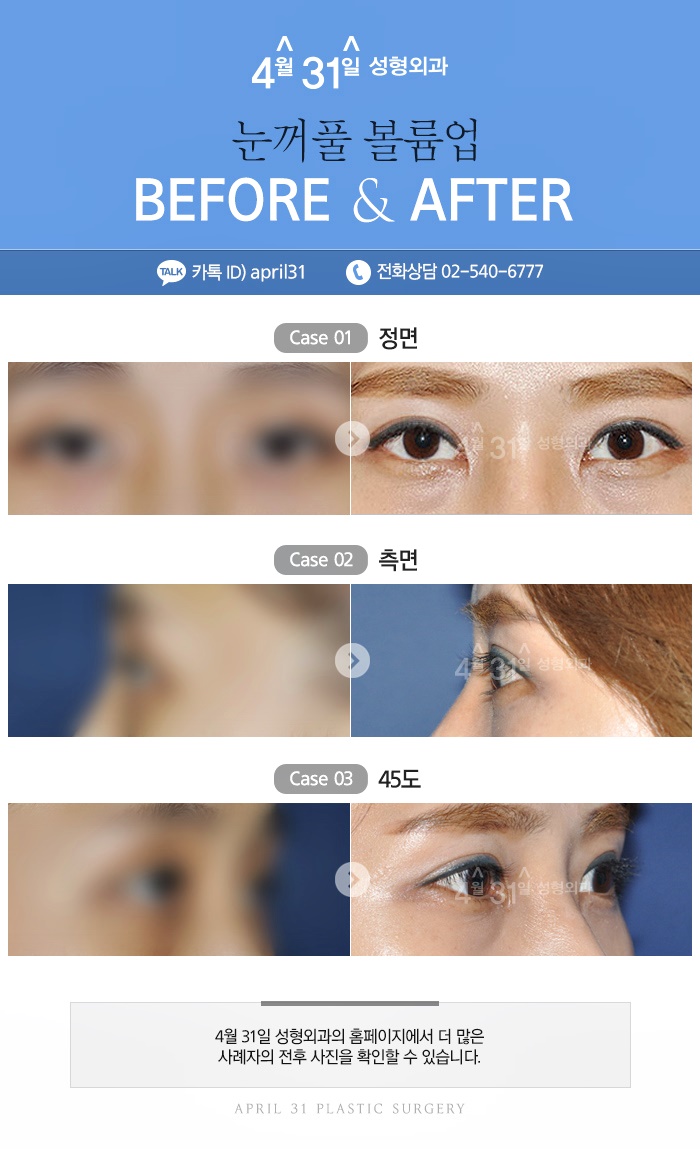 눈꺼풀볼륨업 잘하는곳 4월31일성형외과 관련 이미지 6