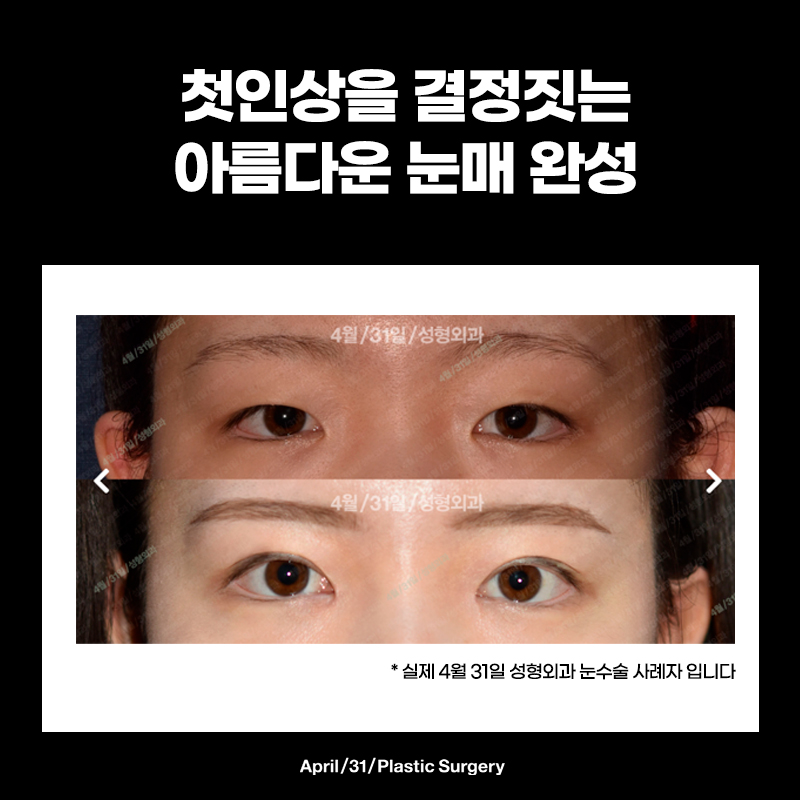 Quick Recovery, Natural-Looking Eyes? Instant Adhesion Double Eyelids image 5