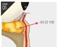 [Eye Plastic Surgery] Middle-Aged Eye Surgery to Improve Uneven Under-Eyes! Lower Blepharoplasty image 4