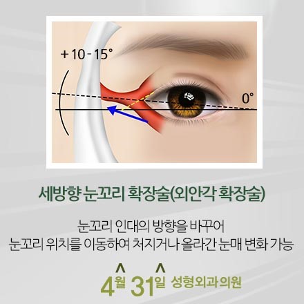 뒤트임성형 세방향눈꼬리확장술 4월31일성형외과의원 관련 이미지 3