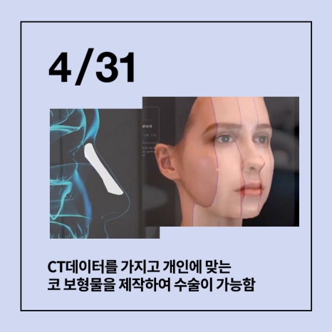 [Rhinoplasty] A Detailed Breakdown of Rhinoplasty Implants! image 5