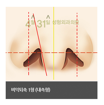 비공내리기 콧구멍교정 잘하는 4월31일성형외과의원에서 관련 이미지 2