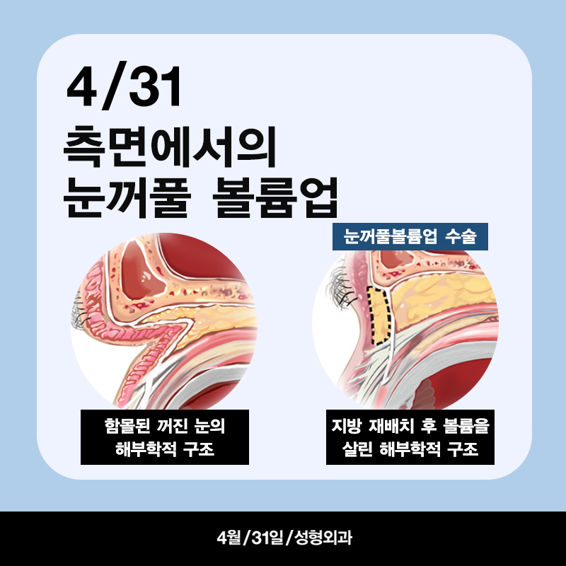 [Eyelid Volume Up] Take Another Look at Sunken Eyes! Eyelid Volume Up Surgery image 4
