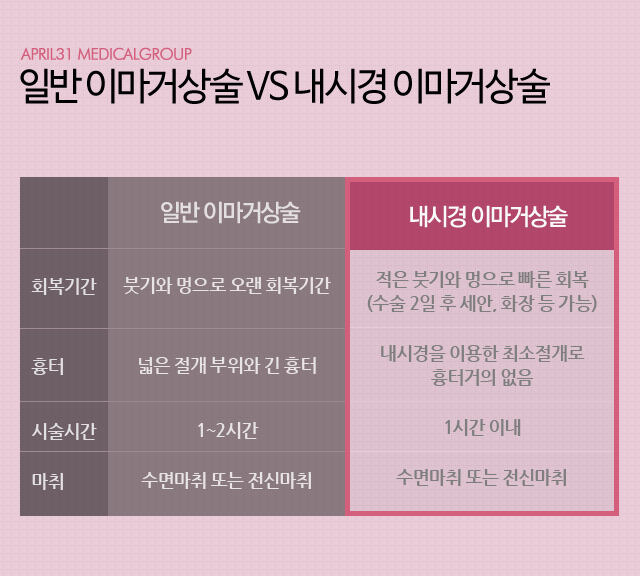 내시경이마거상술 잘하는곳 4월31일성형외과 관련 이미지 2