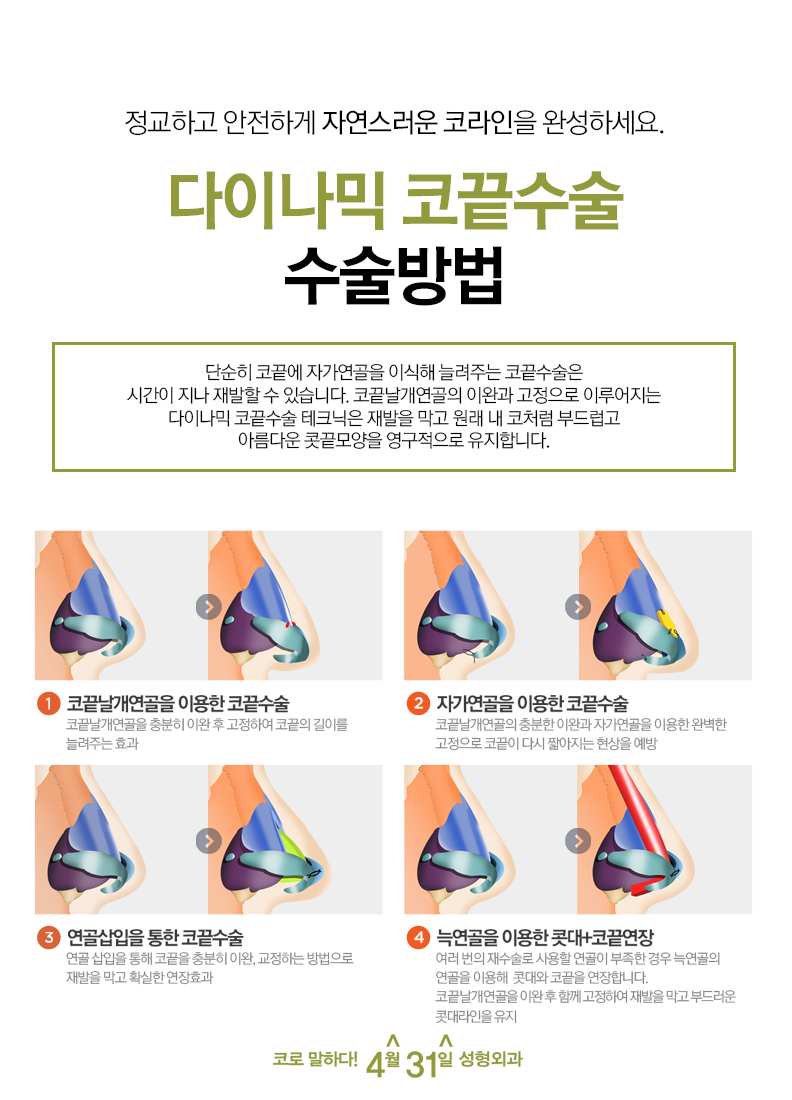 코끝교정 4월31일성형외과 다이나믹코끝수술 관련 이미지 4