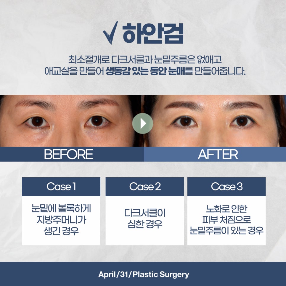 상안검하안검 주름으로 고민이라면? 관련 이미지 4