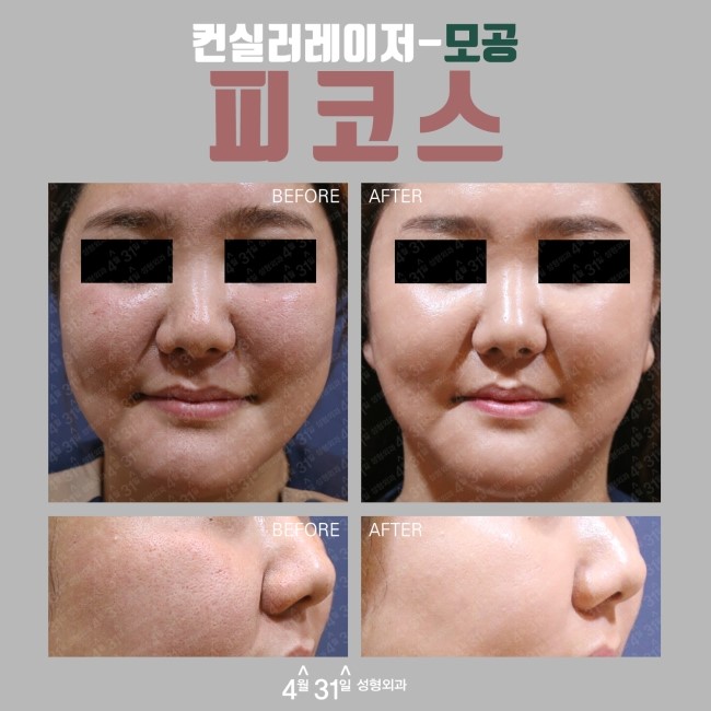 컨실러레이저 피코스레이저 모공축소레이저시술로 가능해 관련 이미지 4