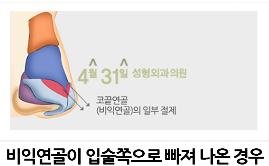 긴코교정 내 얼굴 밸런스에 맞는 코! 관련 이미지 4