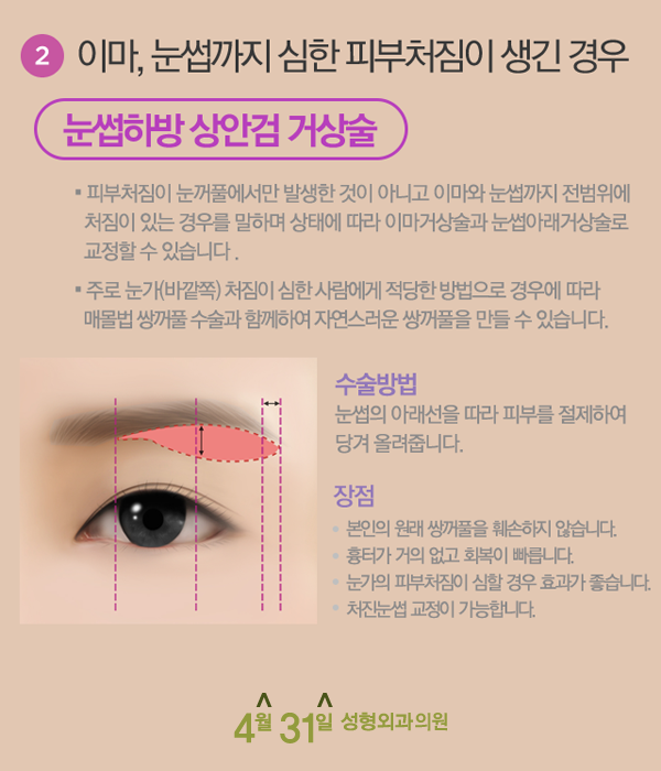 상안검수술붓기 걱정 없는 4월31일성형외과 관련 이미지 3